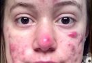 Acne: Types, Causes, Treatment & Prevention